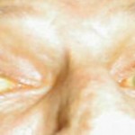 Jaundice, a yellowish appearance of the skin is a classical symptom of liver disease.