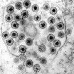 Herpes simplex virus