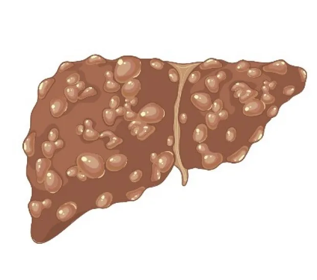 Causes of liver cirrhosis ordered by frequency