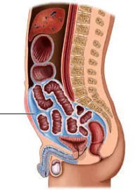 Diagram of fluid buildup in the abdomen (ascites)
