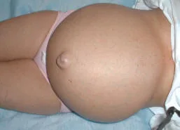 Person with ascites: increased abdominal volume from fluid buildup