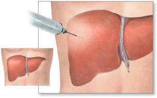 Illustration of a liver biopsy