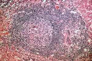 Liver biopsy from a person with primary biliary cholangitis, showing an inflammatory infiltrate of lymphocytes in the portal region and damage to the small bile duct