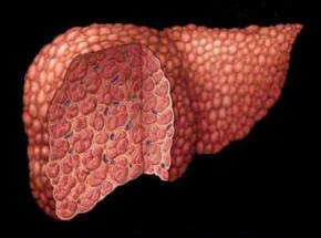 Cirrhosis of the liver