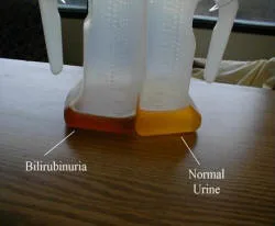 Dark-colored urine in a container, characteristic of choluria