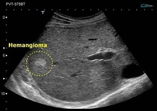Liver hemangioma on a magnetic resonance image