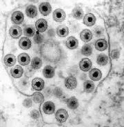 Herpes simplex virus