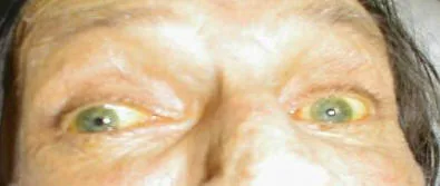Yellow discoloration of the sclerae (the whites of the eyes) from jaundice
