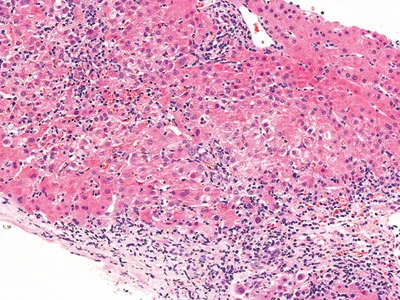 Hepatitis portal